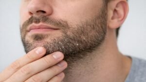 Caspa na barba com descamação no queixo causada por dermatite seborreica facial