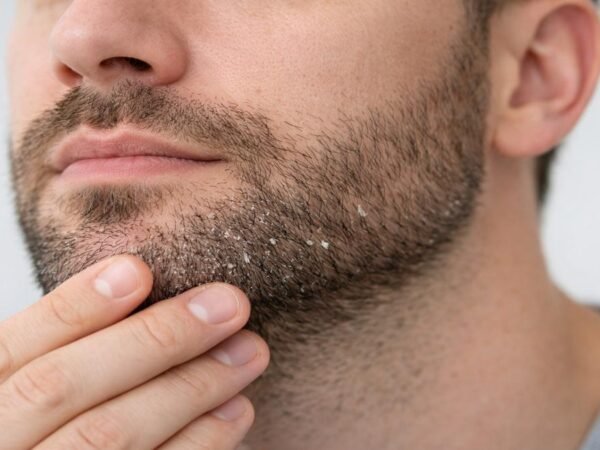 Caspa na barba com descamação no queixo causada por dermatite seborreica facial