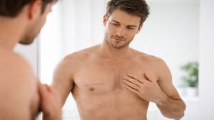 cicatriz da ginecomastia em fase inicial de recuperação