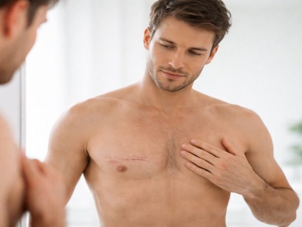 cicatriz da ginecomastia em fase inicial de recuperação
