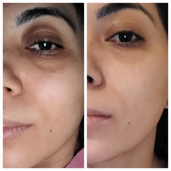 Foto comparativa antes e depois do uso do sérum Principia Mix-03 na área dos olhos, mostrando clareamento e melhora da textura.
